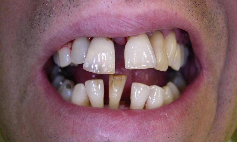 Wax Spacer Designs In Complete Dentures Zion IL 60099